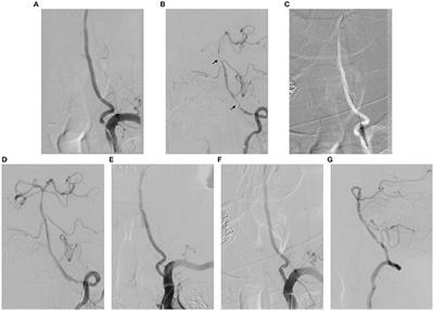 Simultaneous Stenting for Symptomatic Tandem Extracranial and Intracranial Posterior Circulation Stenoses: Long-Term Outcomes and Procedural Experience